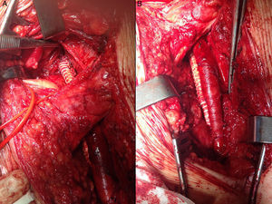 Cirugía de ampliación de bordes con resección de vena femoral y reconstrucción mediante injerto término-terminal de PTFE con anastomosis proximal en vena ilíaca externa (A: espacio retroperitoneal izquierdo) y distal en vena femoral común (B: región inguinal izquierda).
