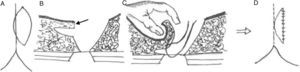 Esquema de la técnica empleada. A1: marcaje en la piel de la elipse excéntrica a 2 cm de la línea media. B1: se identifica con una flecha el tallado de un colgajo en el borde medial de 1 cm de grosor y 2 cm de extensión. C1: sutura del borde inferior e interno del colgajo a la fascia presacra para cubrir el defecto. D1: resultado final, con una sutura.