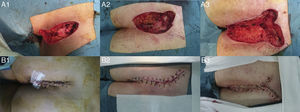 Imágenes quirúrgicas de los 3 pacientes, antes y después del tiempo reconstructivo. A1 y B1: paciente 1; A2 y B2: paciente 2 y, A3 y B3: paciente 3.