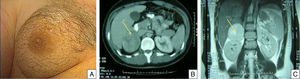 A) Detalle del hirsutismo torácico. B) Tomografía computerizada. C) Resonancia magnética. La flecha señala la tumoración.