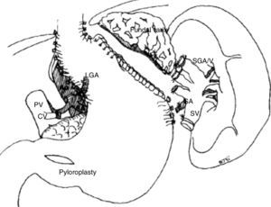 Devascularización esofagogástrica según técnica de Han. Han HS et al.7.