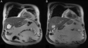 A y B) Absceso en segmento V hepático de 4,4×5cm.