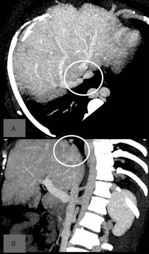 TC abdominal. Estenosis VCI. A) Axial. B) Sagital.