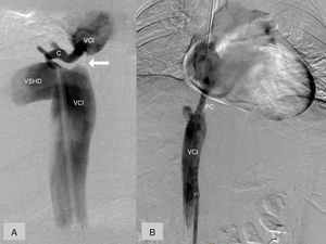 Cavografía. A) Diagnóstica. Obstrucción completa VCI (flecha), VSH derecha dilatada (VSHD), colateral (C) que conecta la VSH derecha con la VCI por encima de la estenosis. B) Terapéutica. Prótesis cubierta (PC) conectando los segmentos preestenótico y postestenótico de la VCI.