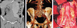A) Imagen angio-TC que muestra aneurisma de aorta abdominal infrarrenal roto asociado a aneurisma iliaco izquierdo. B) Imagen angio-TC que muestra la correcta colocación de un EVAR aortomonoiliaco asociado a baipás femorofemoral. C) Cirugía abierta con realización de resección aneurismática más injerto aortobiiliaco.