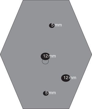 Colocación de los trocares para el abordaje laparoscópico de la Enfermedad de Crohn ileocecal.