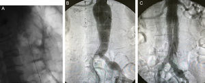 A) Imagen de control tras la colocación de stent a nivel de colon descendente. B) Imagen intraoperatoria de AAA infrarrenal. C) Imagen intraoperatoria tras la realización de EVAR con endoprótesis aorto-bi-ilíaca con correcta exclusión aneurismática.