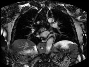 Corte coronal de la RMN, donde se puede apreciar un tumor toracoabdominal de 6cm situado en el hiato aórtico (marcado con una estrella) que se prolonga hasta el retroperitoneo. A los lados de la lesión se observa la íntima relación con la aorta torácica y el diafragma.