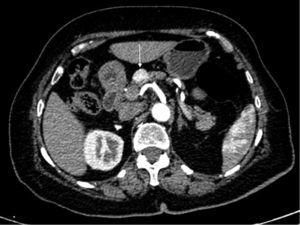 Lesión sólida, de 16×19 mm en el istmo del páncreas (flecha), marcadamente hipervascular en fase arterial, compatible con tumor neuroendocrino.