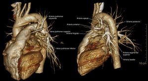 Reconstrucción volumétrica, relación de las arterias lobares y segmentarias izquierdas con las venas pulmonares: a) visión lateral; b) visión posterolateral.