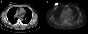 PET-TC: A) Tomografía computarizada en la que se aprecia una masa de 4×3,5cm en la mama derecha. B) Tomografía por emisión de positrones en la que se evidencia una masa hipercaptante en la mama derecha con SUVmáx de 12.