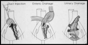 Modelos de trasplante pancreático: A) inyección con polímeros; B) derivación intestinal; C) derivación vesical. Tomado de Sutherland.
