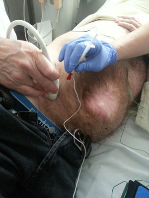 Infiltración de TB en un paciente bajo control electromiográfico.
