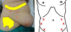 Localización de puntos de infiltración de la TB: modelo de Ibarra-Hurtado (izquierda) y modelo de Smooth (derecha).