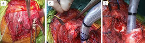a) Colocación de los estimuladores siguiendo la disección bilateral de los haces neurovasculares. b) Inserción de los electrodos en la musculatura intralaríngea por punción bilateral del cartílago tiroides cerca de la zona de las cuerdas vocales. c) Resección de la mucosa del sello del cricoides, del anillo cricoideo y de los 4 primeros anillos traqueales. Intubación intracampo de la tráquea distal.