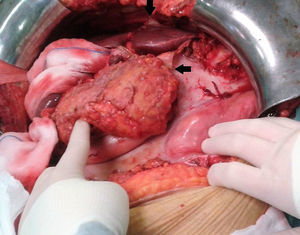 Imagen intraoperatoria: membrana fibrosa blanca-nacarada englobando parte de los órganos de la cavidad abdominal. Las flechas señalan los extremos de dicha membrana, tras haber sido seccionada para facilitar un cómodo proceder quirúrgico.