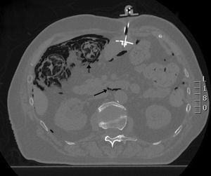 TC imagen axial. Presencia de neumoperitoneo y retroneumoperitoneo. Colon derecho de aspecto estriado, en capas, con presencia de gas en la pared. PEG.