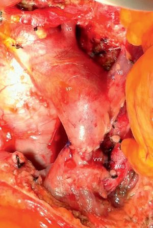 Imagen intraoperatoria tras la resección de adenocarcinoma de páncreas borderline resectable con obliteración de la vena mesentérica superior y VP. En la imagen se aprecia la anastomosis venosa terminoterminal entre la VMS y la confluencia de la vena ileocólica y la VYY. AMS: arteria mesentérica superior; VC: vena coronaria; VE: vena esplénica; VP: vena porta; VYY: vena yeyunal.
