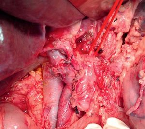 Imagen intraoperatoria (paciente comentado en fig. 1) tras la resección de la cabeza pancreática por neoplasia periampular y previamente a la resección del páncreas distal. Se evidencia adenocarcinoma de páncreas borderline resectable con afectación de AHC, arteria esplénica y TC. AGDd: arteria gastroduodenal; AH: arteria hepática; AHC: arteria hepática común; TC: tronco celíaco; TM: tumor del cuerpo pancreático; VP: vena porta.