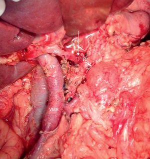 Imagen intraoperatoria (paciente comentado en figs. 1-3) tras embolización arterial en 2tiempos y ulterior duodenopancreatectomía total, gastrectomía 4/5, esplenectomía, resección del TC y anastomosis arterial terminoterminal. En la fotografía se aprecia la anastomosis arterial entre TC y la AH común marcada con una flecha. AH: arteria hepática; TC: tronco celíaco; VMS: vena mesentérica superior; VP: vena porta.