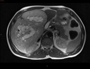RMN: secuencia potenciada en T2, en plano axial, mostrando una gran masa de bordes bien delimitados, exofítica, dependiente de segmentos hepáticos V-VI, con efecto compresivo sobre estructuras extrahepáticas sin aparente infiltración de las mismas y con área central extensamente necrosada o degeneración quística.