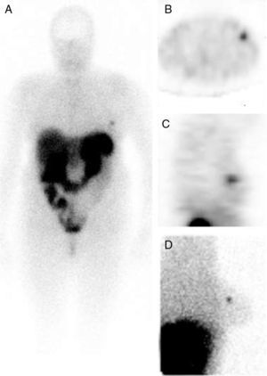 Las imágenes del cuerpo entero (A), SPECT (vista axial [B], vista sagital [C]) y planar lateral izquierda en posición de decúbito prono (D) identificaron un aumento de la captación focal en la mama izquierda.