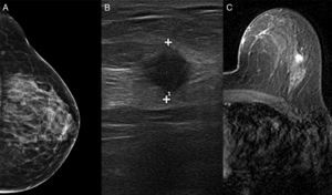 La mamografía (A) mostró tejido fibroglandular. La ecografía (B) identificó un nódulo de 10mm dentro de la mama izquierda. La resonancia magnética (C) localizó la lesión en el cuadrante superior externo de la mama izquierda con características cinéticas malignas.