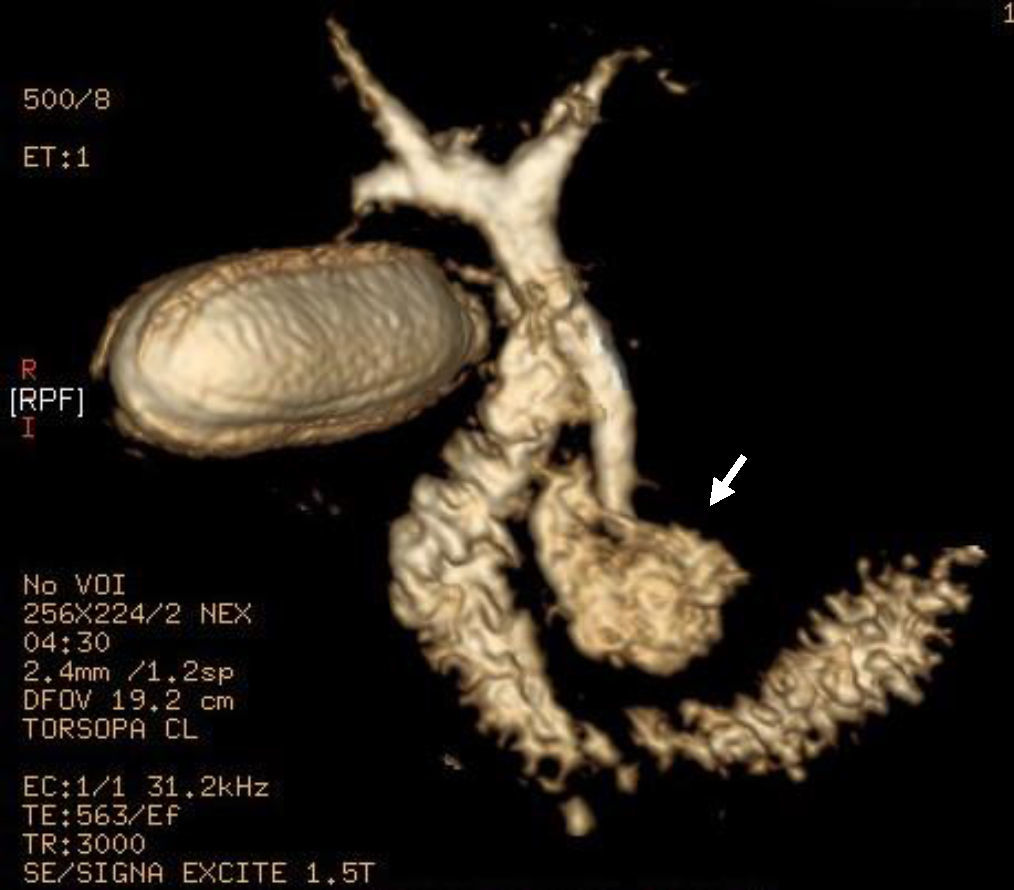 s-ndrome-de-lemmel-ictericia-obstructiva-secundaria-a-divert-culo
