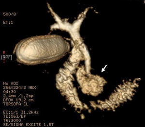 Reconstrucción 3D donde se observa dilatación del hepatocolédoco proximal con afilamiento distal por compresión extrínseca de un gran divertículo duodenal (flecha).