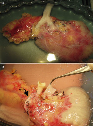 a) Reconstrucción arterial del injerto pancreático mediante anastomosis con un segmento de la bifurcación ilíaca del donante. b) Reconstrucción arterial del injerto pancreático mediante anastomosis esplenomesentérica terminoterminal (flecha).