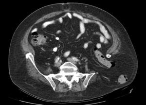 TAC abdominal, sección axial: hernia de intestino grueso a través del defecto óseo del ala ilíaca. Hernia umbilical.