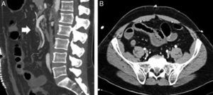 A) Angio-TC en el que se evidencia pequeño defecto de repleción en el origen de la arteria ileocólica (flecha blanca). B) Asas ileales localizadas con paredes engrosadas que sugieren sufrimiento intestinal.