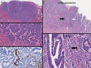 A y B) Metástasis hepática. C) Sinaptofisina. D y E) Tumor que muestra tanto el componente adenocarcinoma (flecha blanca) y componente neuroendocrino (NE) (flecha negra).