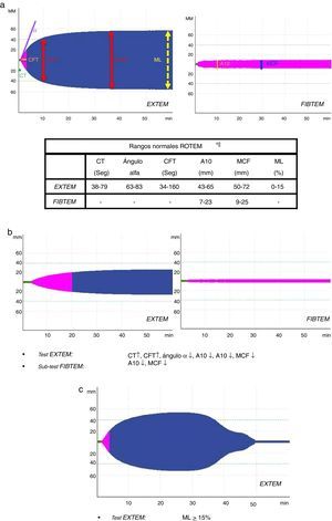 Esquema de perfiles y parámetros ROTEM®. a) Patrón y valores ROTEM® «normales» (test EXTEM y sub-test FIBTEM). b) Patrón ROTEM® con «hipocoagulabilidad» (test EXTEM y sub-test FIBTEM). c) Patrón ROTEM® con «hiperfibrinólisis» (test EXTEM). A10: amplitud del coágulo; CFT: tiempo de formación del coágulo; CT: tiempo de coagulación; EXTEM: test de la vía extrínseca; FIBTEM: sub-test del fibrinógeno; MCF: máxima amplitud/firmeza del coágulo; ML: máxima lisis del coágulo.