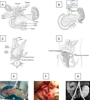 A)Técnica de la extracción de páncreas en donante. B)Banco: anastomosis del injerto ilíaco arterial en Y con arteria mesentérica superior (AMS) y arteria esplénica (AE) del injerto. C)Implante en fosa ilíaca derecha: anastomosis arterial entre el extremo del injerto en Y con la arteria ilíaca común o externa del receptor y anastomosis venosa entre la vena porta del injerto con la vena ilíaca común o vena cava del receptor y anastomosis duodeno-vesical con grapadora mecánica. D)Implante en fosa ilíaca derecha con anastomosis duodeno-yeyunal latero-lateral con cabeza de páncreas en posición craneal. E)Injerto en banco. F)Anastomosis vasculares e injerto reperfundido. G)Imagen de RM con injerto pancreático en fosa ilíaca derecha y renal en fosa ilíaca izquierda.