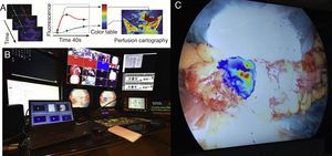 A) Descripción del concepto de FLER (fluorescence-based enhanced reality): tras la inyección del fluoróforo, la señal fluorescente es analizada durante 40 s por un software adecuado (VR-PERFUSION, IRCAD, Francia). El tiempo hasta la máxima fluorescencia es computado píxel a píxel y los valores de la curva se convierten en un código de color para generar una cartografía de perfusión virtual. La cartografía resultante se sobrepone utilizando un vídeo mezclador (B: estudio de grabación del IRCAD) y es sobrepuesta en tiempo real sobre el intestino (C: punto de sección proximal durante una sigmoidectomía).