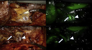 A) Imagen del área del triángulo de Calot con luz blanca tras la disección inicial del tejido adiposo del hilio vesicular. Se puede identificar una estructura tubular. B) Bajo luz infrarroja se identifica una nueva estructura adyacente a la otra, que permite identificarla como conducto cístico (CD, flecha) y la vía biliar (CBD) flecha gruesa). C) Imagen con luz blanca tras progresar la disección visualizando el conducto cístico. D) La imagen infrarroja confirma la adecuada interpretación de la anatomía.