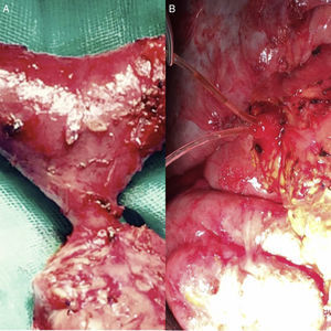 A) Inserción de la papila en la región duodeno pancreática. B) Sección de la papila a nivel de su base; conductos biliar y pancreático tutorados.