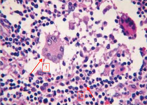 Imagen histológica de la MGI. Tinción hematoxilina-eosina. Granuloma con células gigantes multinucleadas tipo Langhans (flecha 1) e infiltrado inflamatorio linfoplasmocitario (flecha 2).