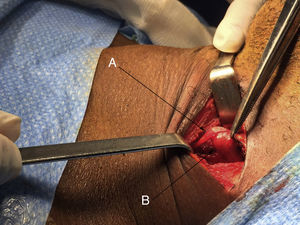 A) Nervio vago. B) Adenoma intravagal.