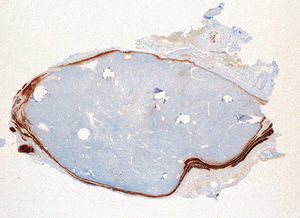 La proteína S100 identifica el tejido neuronal que rodea el adenoma, ×20.
