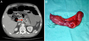 TAC abdominal donde se identifica el punto de obstrucción (A) y la pieza quirúrgica (B).