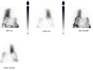Imagen de gammagrafía con Tc-99 en la que se objetiva fuga del radiotrazador hacia hemitórax derecho.