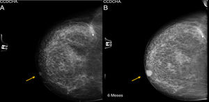 A) Mamografía de mama derecha BIRADS-1. B) Control a los 6 meses de esa misma mama, BIRADS-2.
