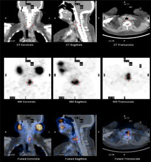 Identificación de remanentes tiroideos en SPECT-CT tras la administración del radiofármaco. En las imágenes de SPECT-CT se identifican los restos tiroideos y la diferenciación del acúmulo fisiológico del radiofármaco en otras áreas anatómicas.
