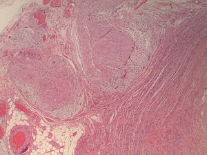 Nidos sólidos de células deciduales en la pared apendicular, a nivel de muscular propia, subserosa y serosa, compatible con deciduosis apendicular.