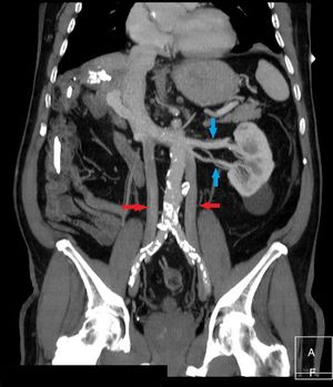 . Flechas rojas: doble vena cava. Flechas azules: doble vena renal.