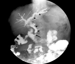 Tránsito baritado. Se observa relleno de todo el árbol biliar (flechas cortas) por existencia de reflujo de contraste (flecha larga) que proviene del asa biliopancreática del cruce duodenal.