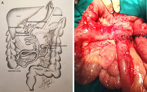 Técnica quirúrgica. A) Se observa esquema de la técnica quirúrgica de transposición de un metro de asa alimentaria a la biliopancreática del cruce duodenal. B) Imagen intraoperatoria que muestra el asa alimentaria (A), el asa biliopancreática (B), el asa común (C) y el segmento intestinal de 1m insertado en medio del asa biliopancreática.