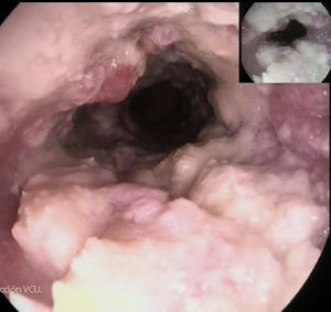 Esófago-gastroscopia: formación mamelonada con candidiasis.